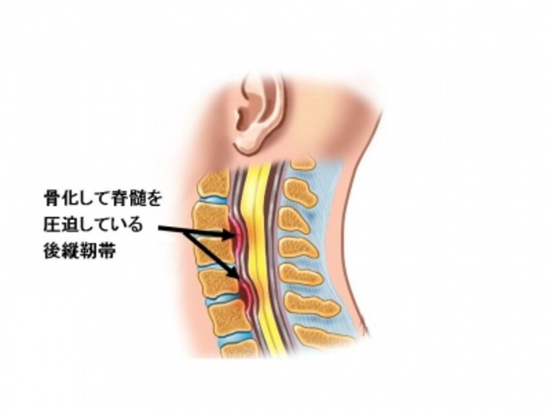 頚椎後縦靭帯骨化症で圧迫される脊髄