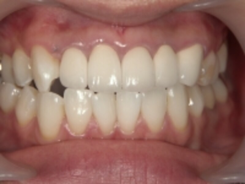 セラミック治療後