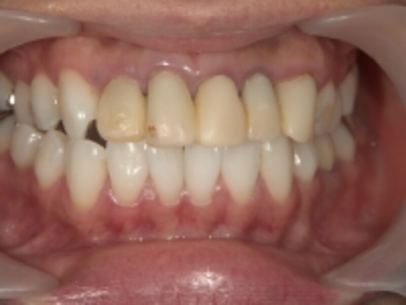 セラミック治療後