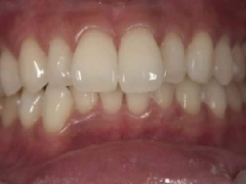 ホワイトニング後