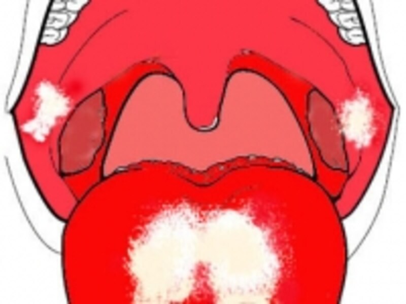 カンジダ