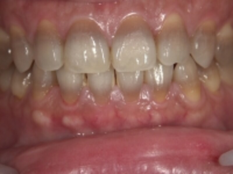 着色歯はホワイトニングでは真っ白になりません