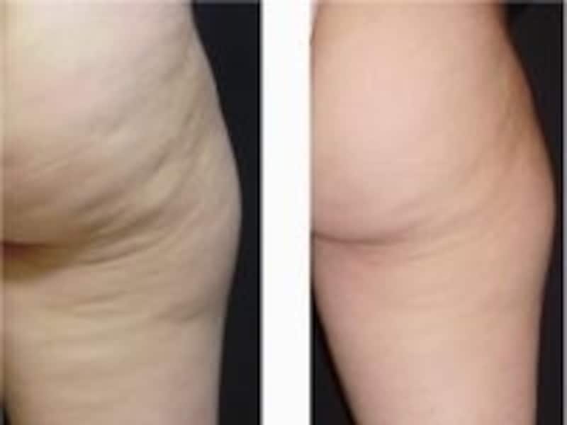 スリムスペック施術