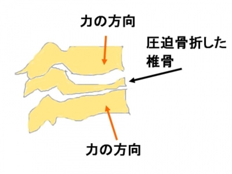 圧迫骨折
