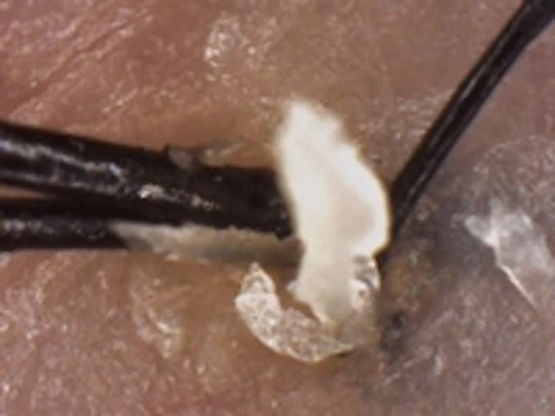 塊となり毛穴をふさぐ「角栓様物質」undefined写真提供:バイオテック