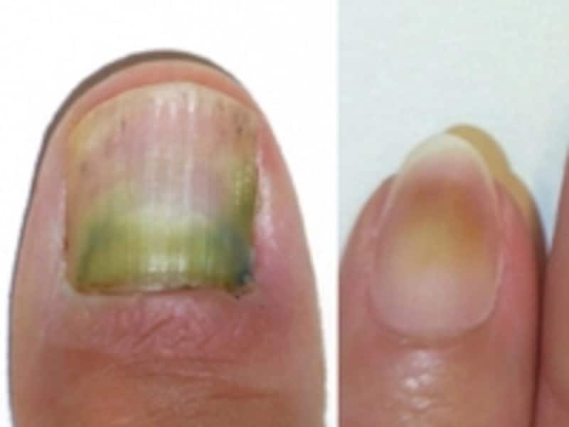 green nail
