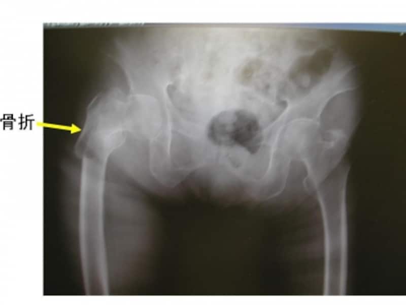 頚部 大腿 骨折 骨 大腿骨頚部骨折の手術方法による違いとは？リハビリのリスクや注意点