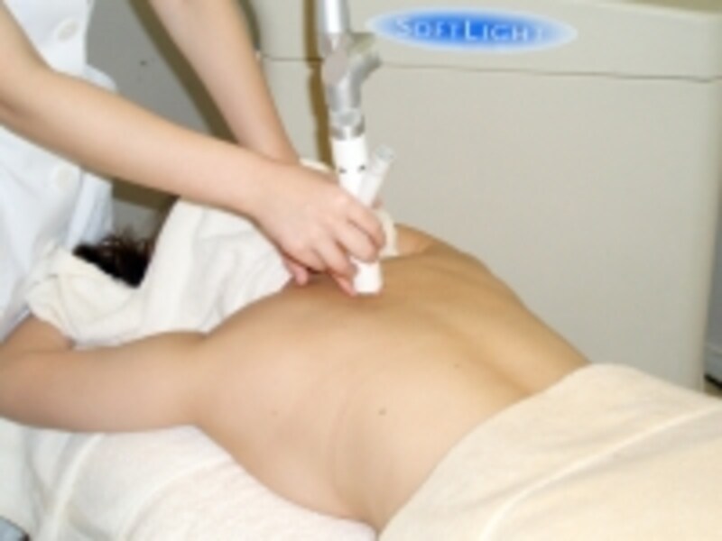 QスイッチYAGレーザー