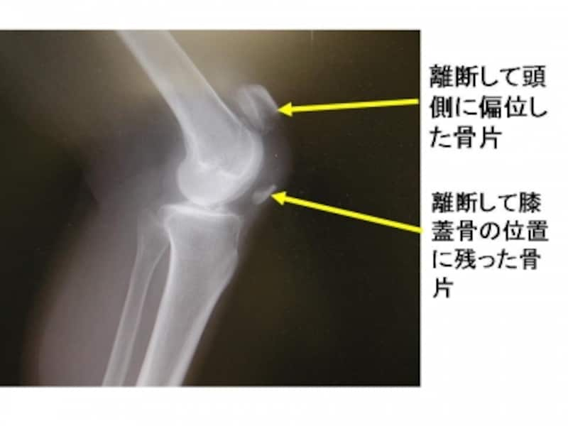 膝蓋骨骨折の症状 診断 治療 骨 筋肉 関節の病気 All About