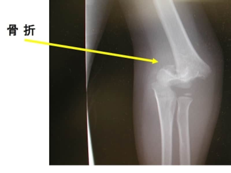 上腕骨遠位端骨折の症状 診断 治療 骨 筋肉 関節の病気 All About
