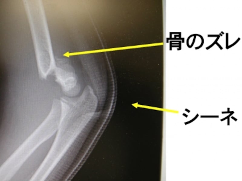 上腕骨遠位端骨折の症状 診断 治療 骨 筋肉 関節の病気 All About