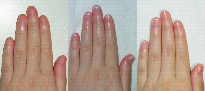 症例画像も 深爪 爪噛みなどによる爪の変形 治療法 皮膚 爪 髪の病気 All About