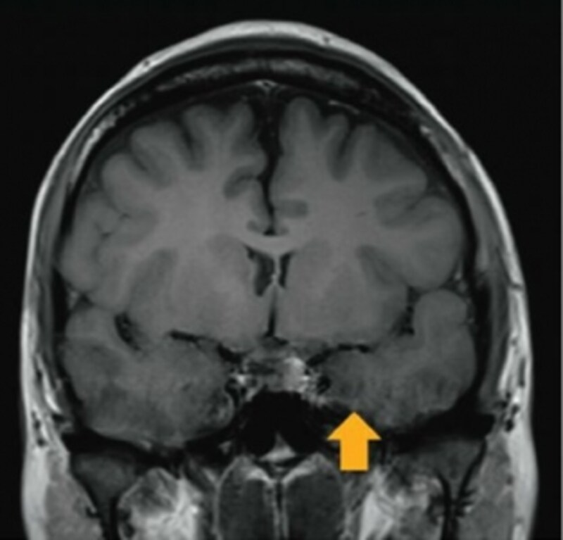 理学療法士国家試験undefined解剖学 脳画像
