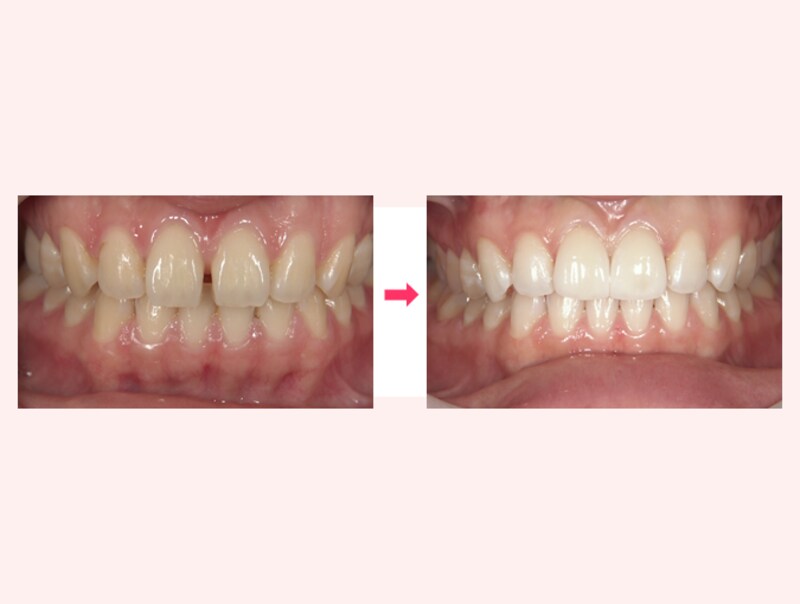 ラミネートベニア治療