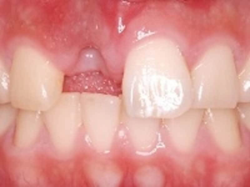 前歯の歯科インプラント治療（術前）