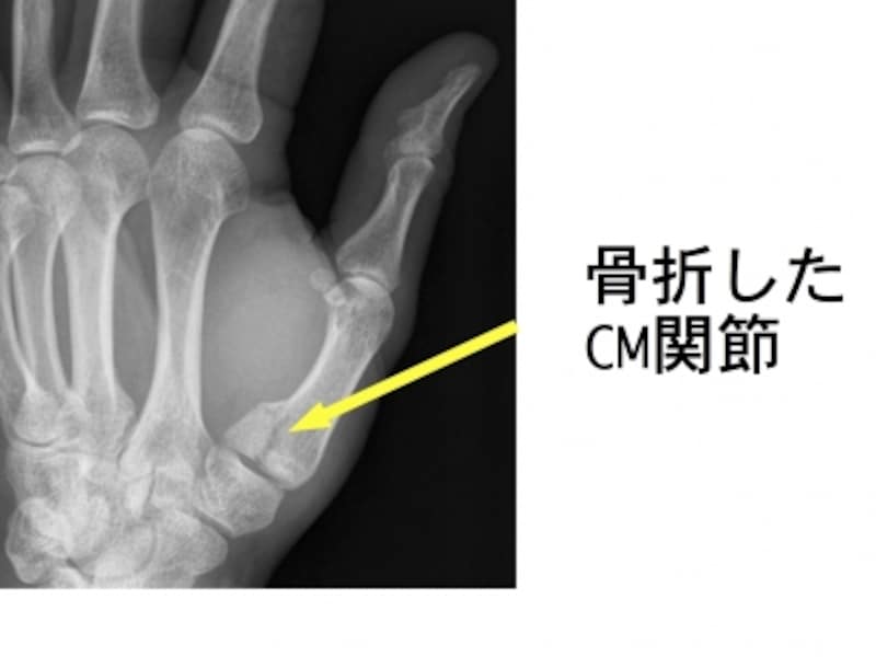 中手骨骨折の一つ ベネット骨折の症状 診断 治療 骨 筋肉 関節の病気 All About