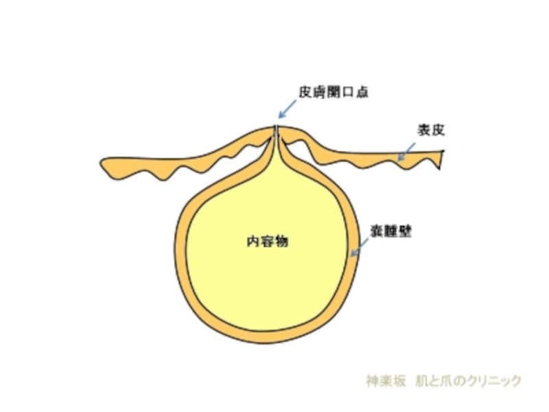 登山者はできやすいか 2度目のアテローム 粉瘤 手術 完了 山旅天空倶楽部 登山者はできやすいか 2度目のアテローム 粉瘤 手術 完了 山旅天空倶楽部