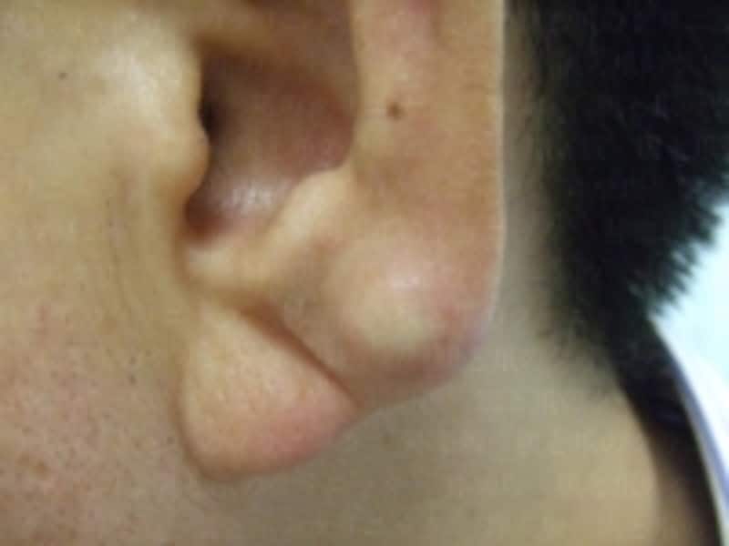 耳の粉瘤