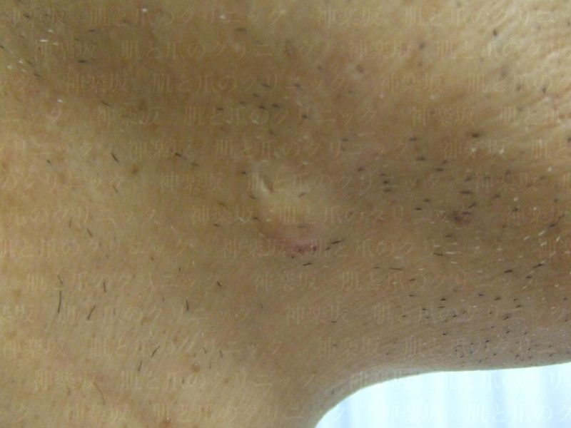 脂肪の塊 皮膚外科医が教えるアテローム 粉瘤 皮膚 爪 髪の病気 All About