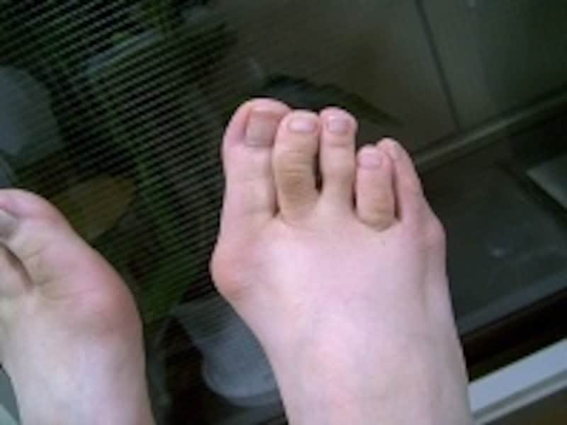 病変性外反母趾