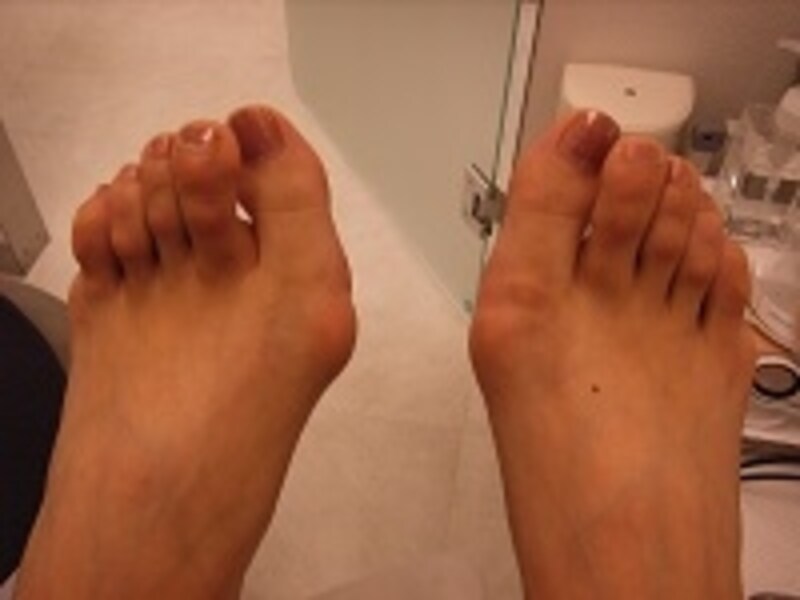 ハンマートゥ性外反母趾