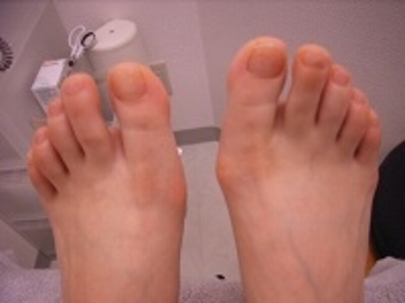 仮骨性外反母趾