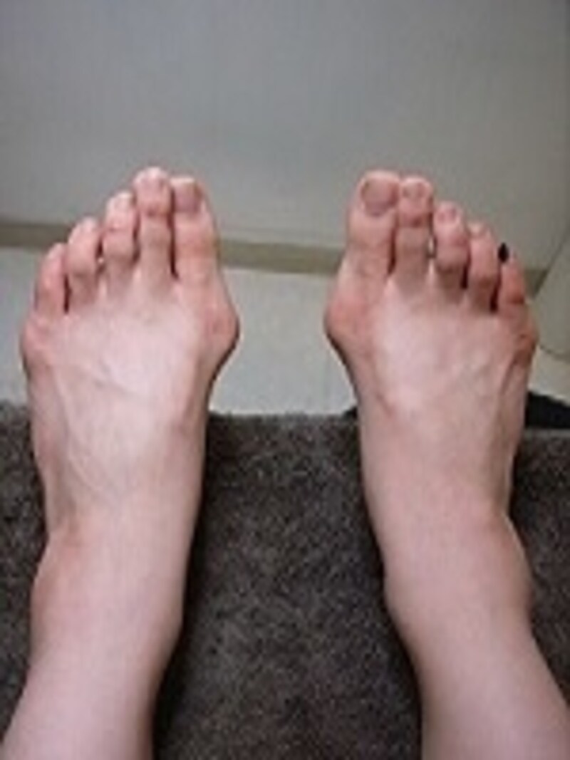 混合性外反母趾