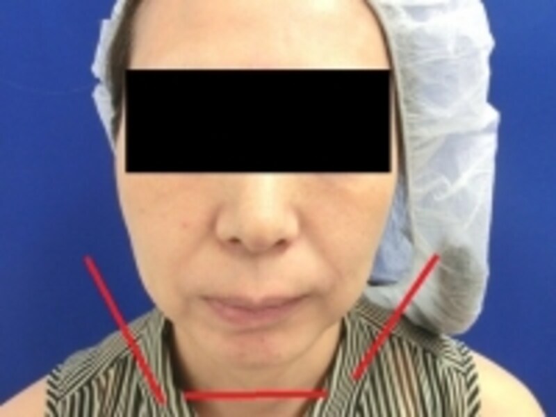 美容外科医がすすめる 小顔になるプチ整形治療5選 美容整形 プチ整形 All About