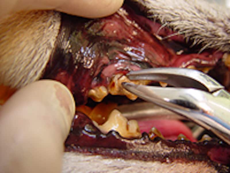 抜歯鉗子で歯石を除去