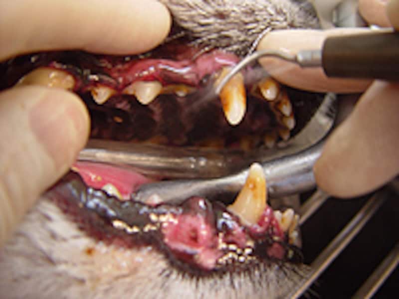 超音波スケラーで歯石を除去