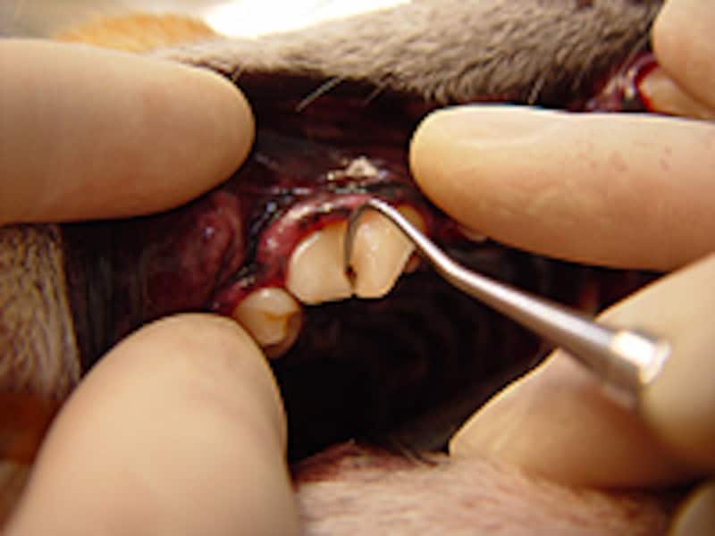 ハンドスケラーで歯石を除去