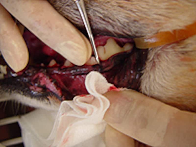 キュレットで歯石を除去し、ルートプレーニング