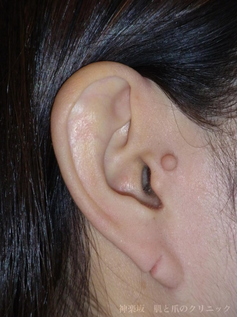 耳のできもの 新生児 大人の副耳とは 切除手術 皮膚 爪 髪の病気 All About