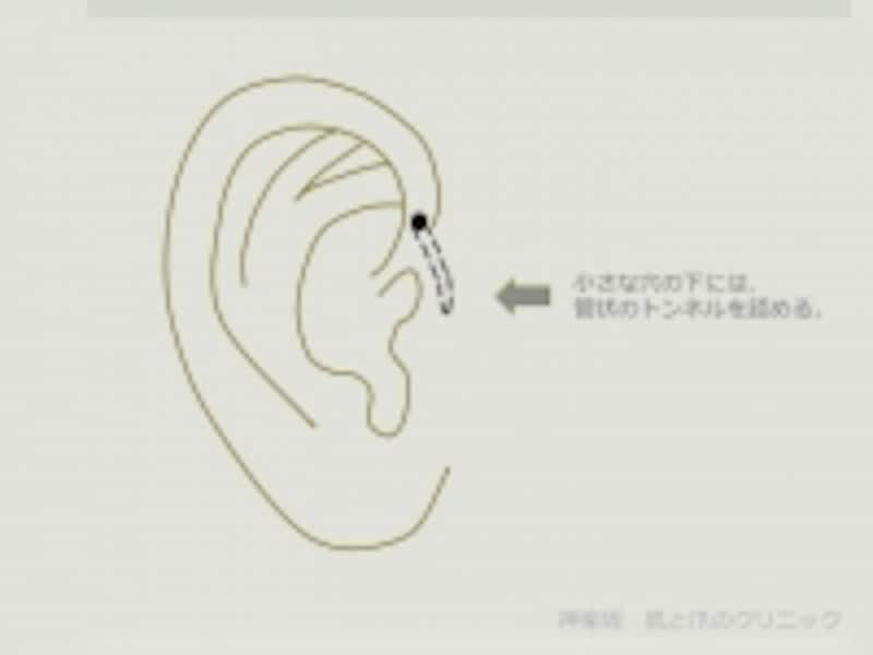 耳瘻孔 先天性耳瘻孔とは 腫れ 臭いがあれば手術も 画像あり 皮膚 爪 髪の病気 All About
