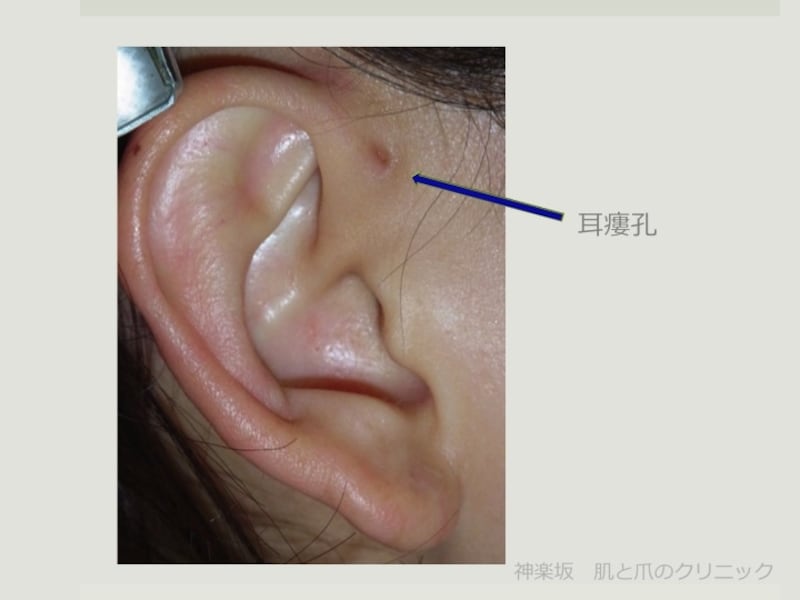 耳瘻孔 先天性耳瘻孔とは 腫れ 臭いがあれば手術も 画像あり 皮膚 爪 髪の病気 All About