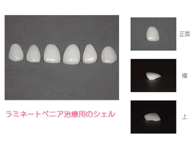 厚さ0.7mmのラミネートベニアシェル