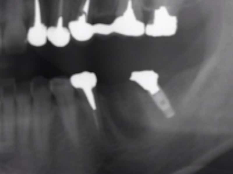 インプラント隣在歯骨欠損