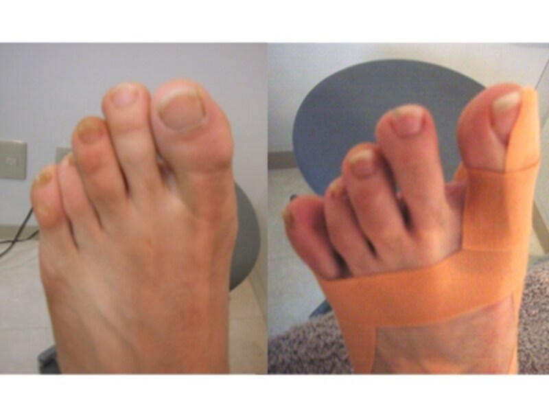 2 2 テーピングによる外反母趾改善法 フットケア All About