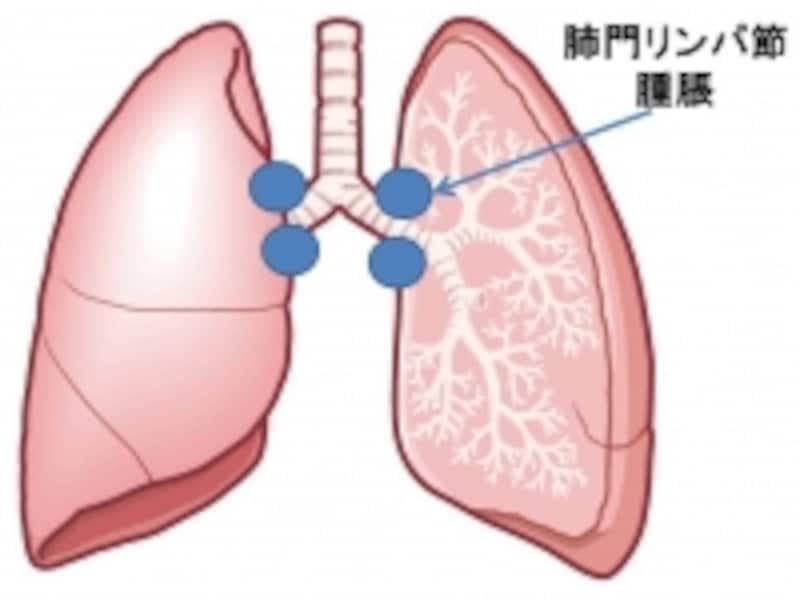 肺門リンパ節腫脹