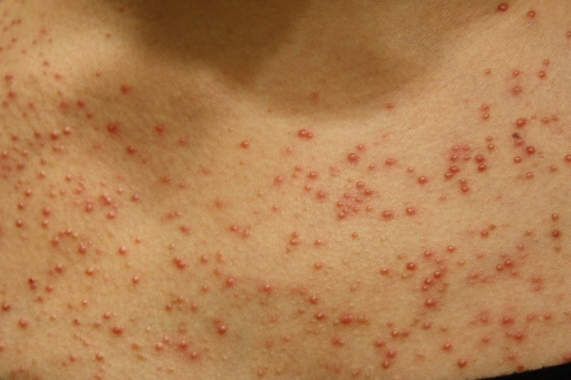 マラセチア毛包炎