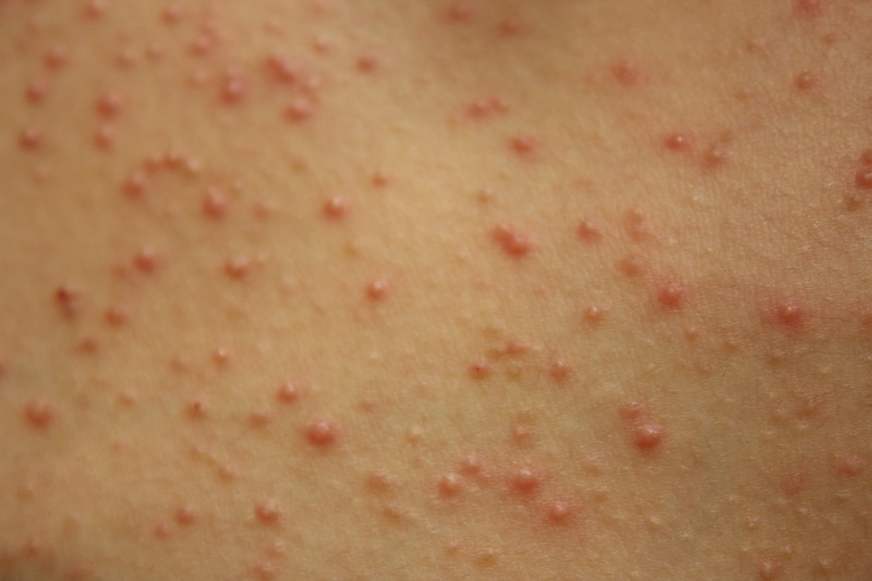 マラセチア毛包炎