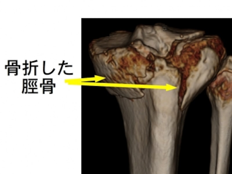 脛骨近位端骨折の症状 診断 治療 骨 筋肉 関節の病気 All About