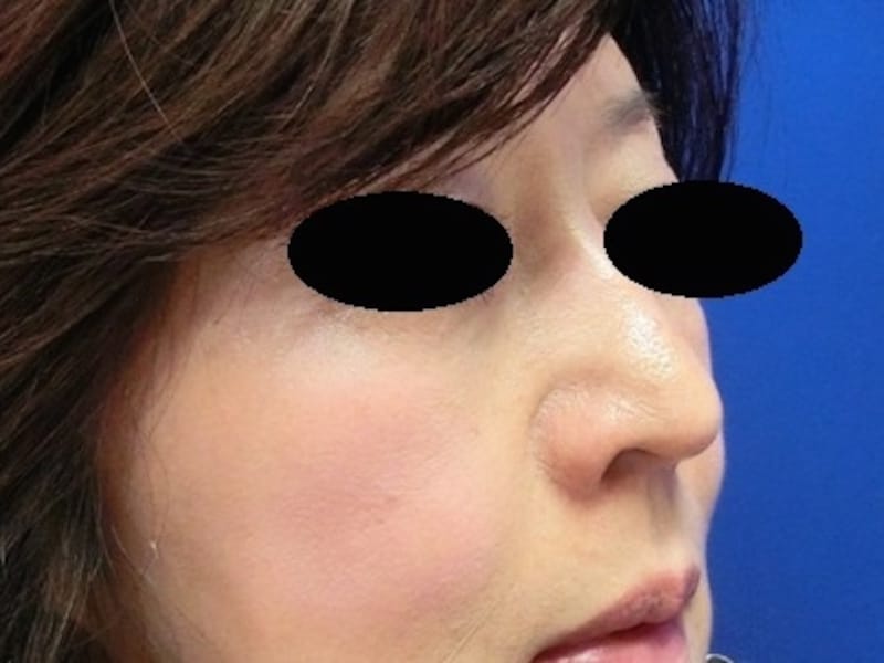 ゴルゴ線を目立たなくしたところ