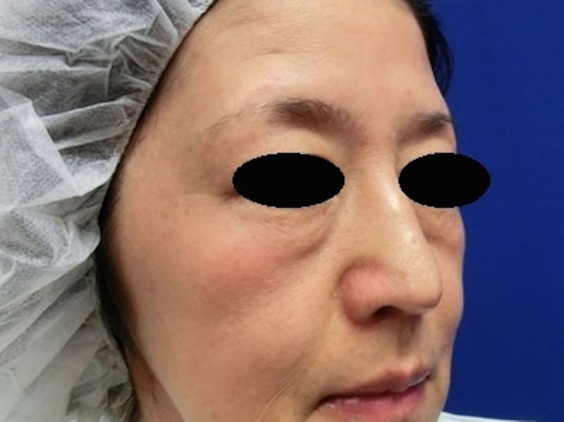 ゴルゴ線の目立つ状態