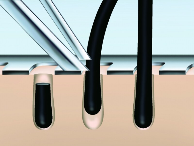 内刃がふたつのコンポーネントによって成り立っているテクノロジーのことで、最初のコンポーネントの部分が毛を毛穴から引き出す役割を担い、引っ張り出しところを、後ろの刃がカットするという仕組みです