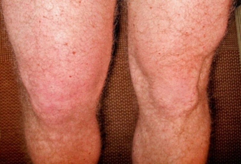 偽痛風と痛風の違いは何ですか?