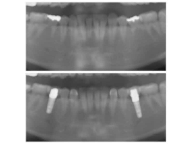 乳歯抜歯後のレントゲン