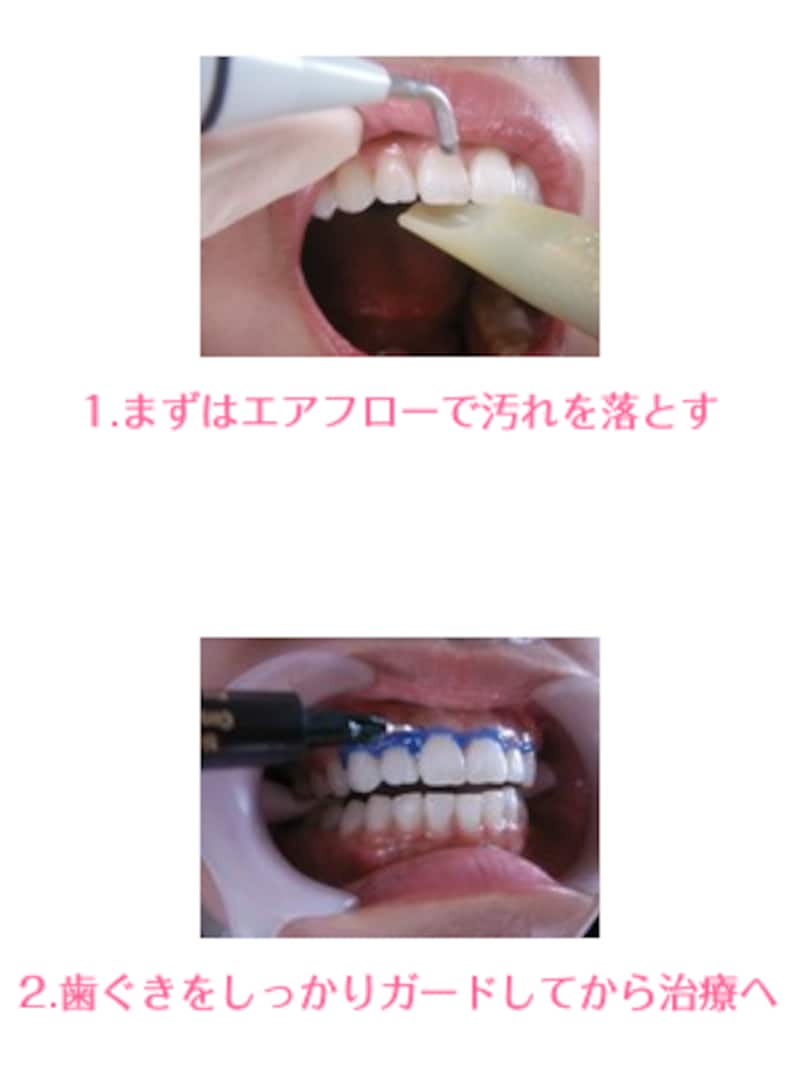 細かなステップが、よりホワイトニングの効果を高めます