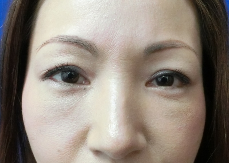 眼窩脂肪の除去と脂肪の注入をした後の写真です