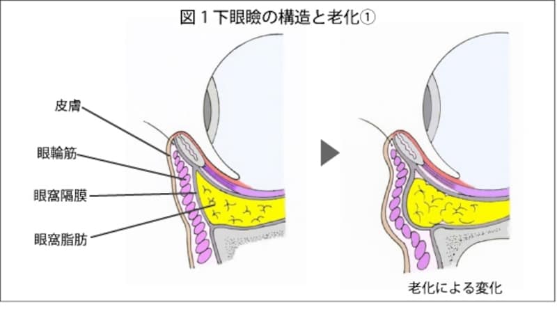 下瞼の構造です。黄色の部分が眼窩脂肪になります